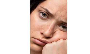 як позбутися пігментації