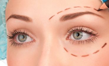 блефаропластика