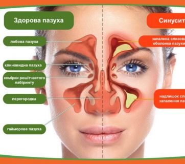 Синусит