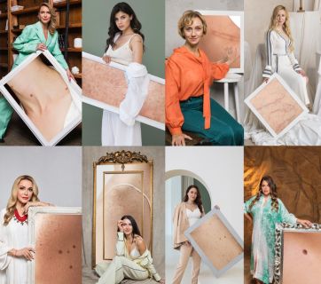 Марина Боржемська, Ольга Сумська, Римма Зюбіна: 16 зірок стали обличчями проєкту проти раку шкіри