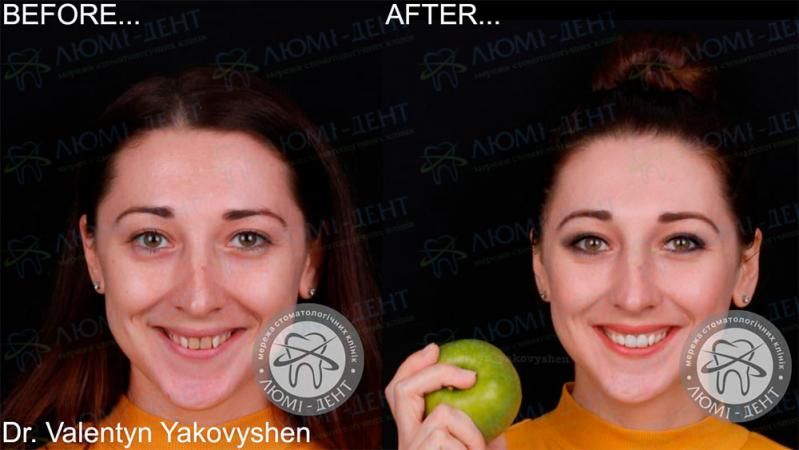 Новая улыбка без секретов: какое протезирование выбрать - Фото №2