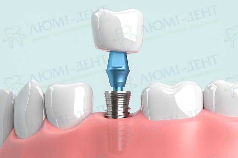 Новая улыбка без секретов: какое протезирование выбрать - Фото №3